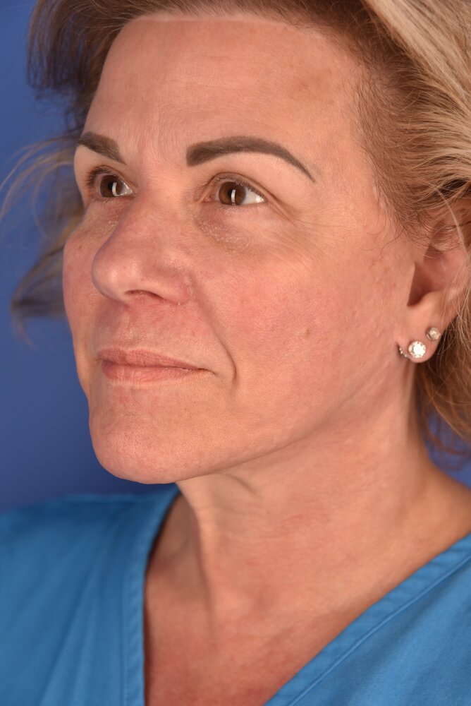 Rhinoplasty Before & After Image