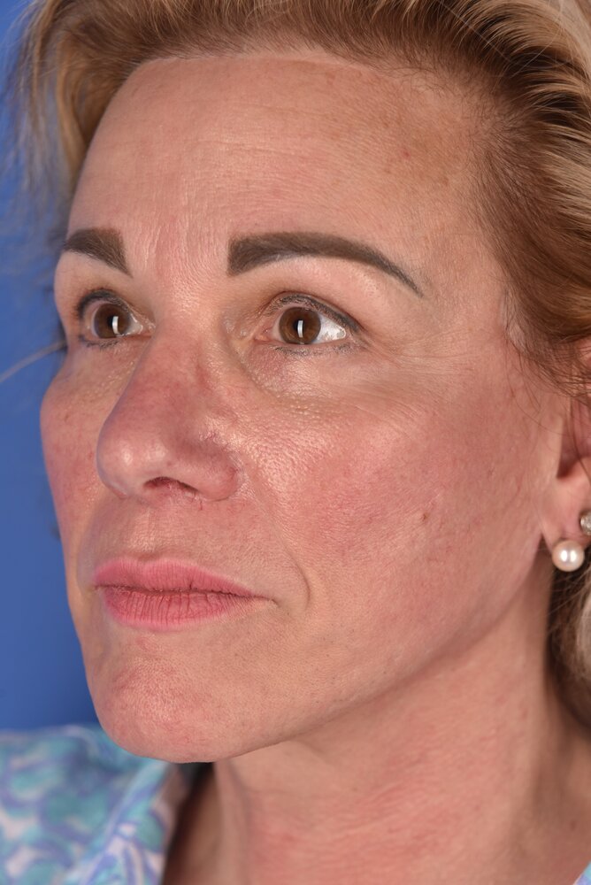 Rhinoplasty Before & After Image