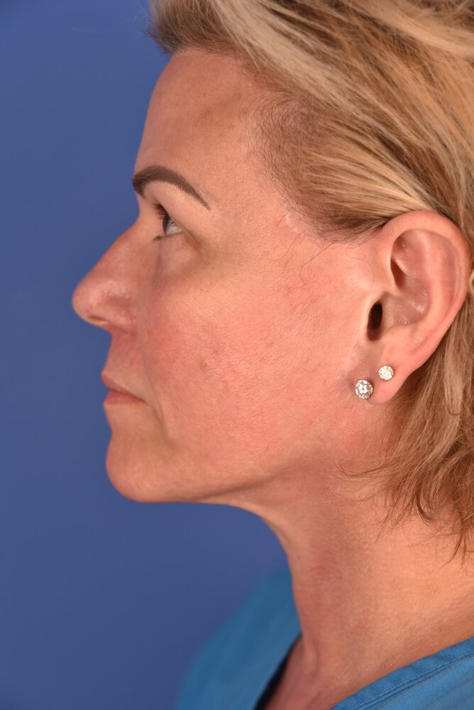Rhinoplasty Before & After Image