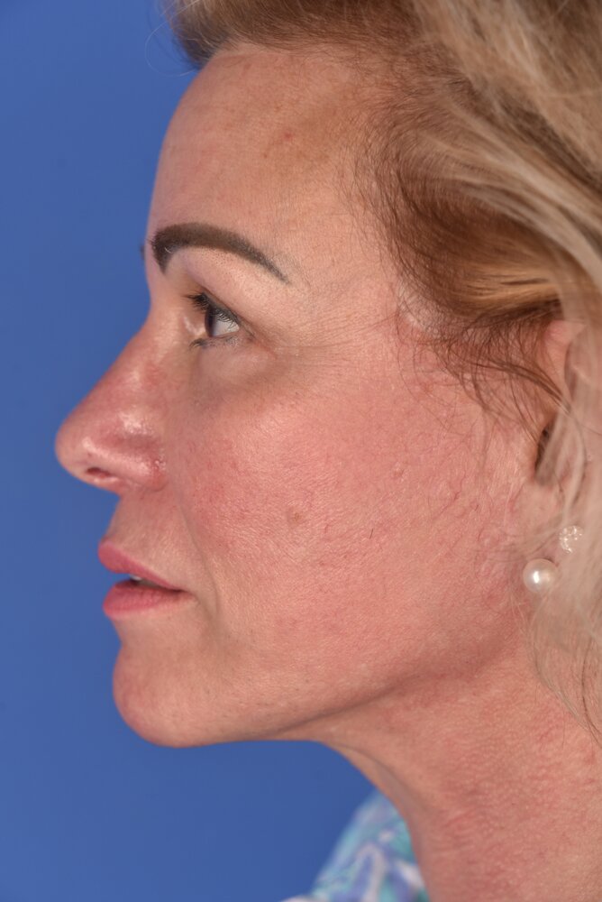 Rhinoplasty Before & After Image