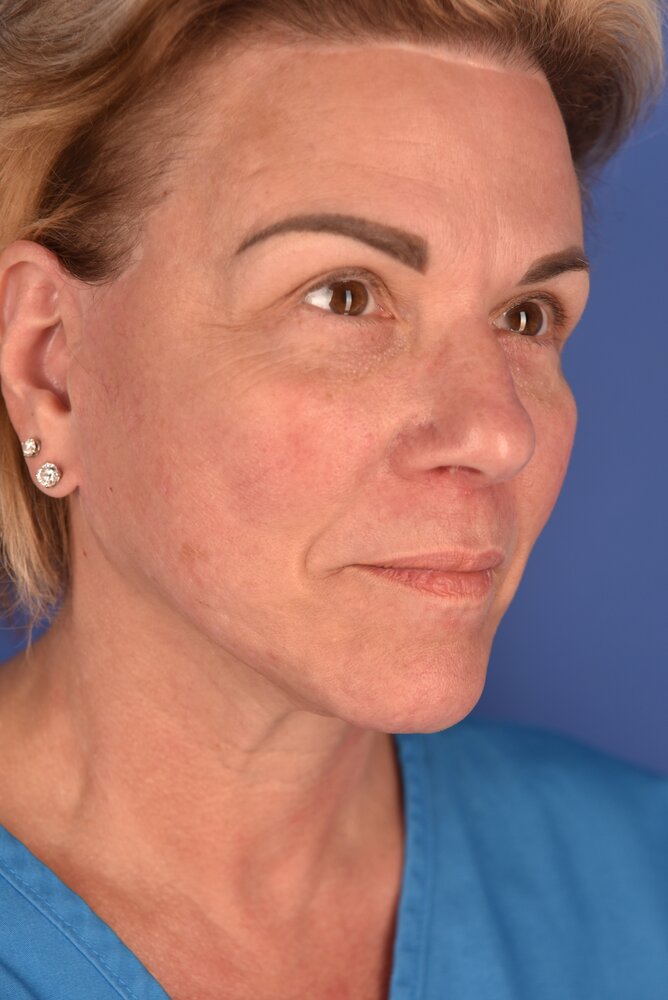 Rhinoplasty Before & After Image