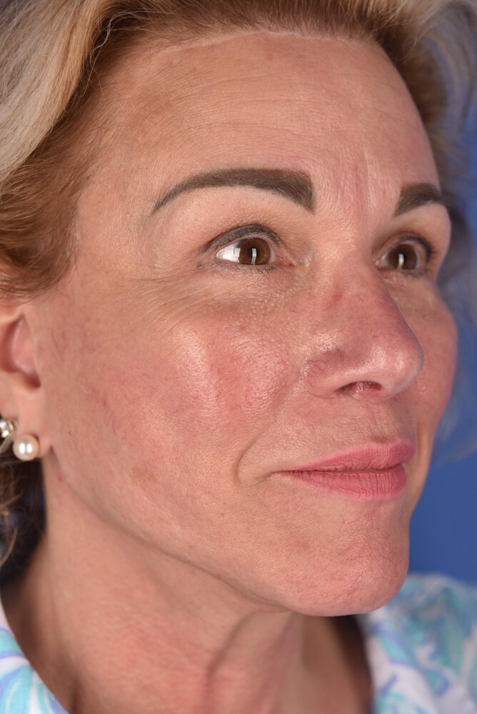 Rhinoplasty Before & After Image