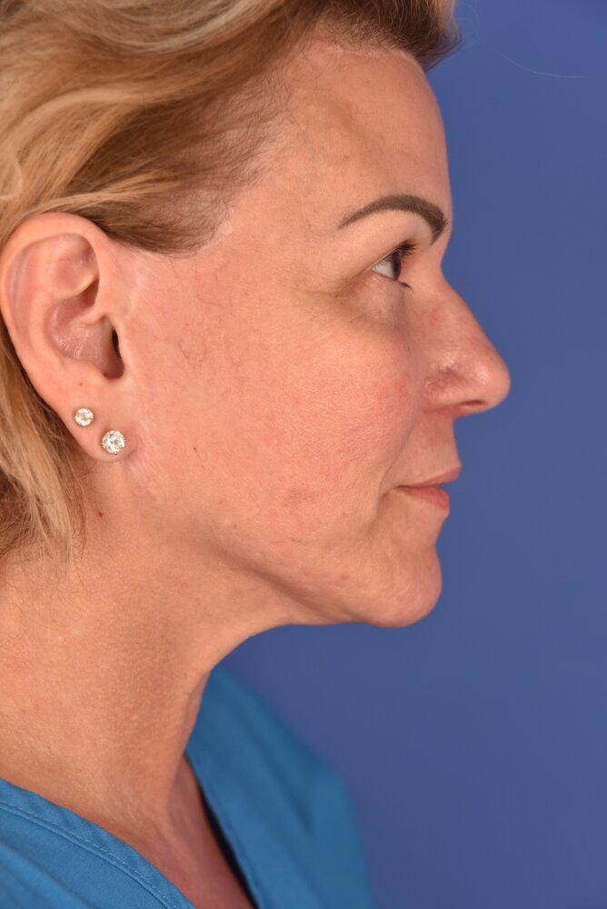 Rhinoplasty Before & After Image