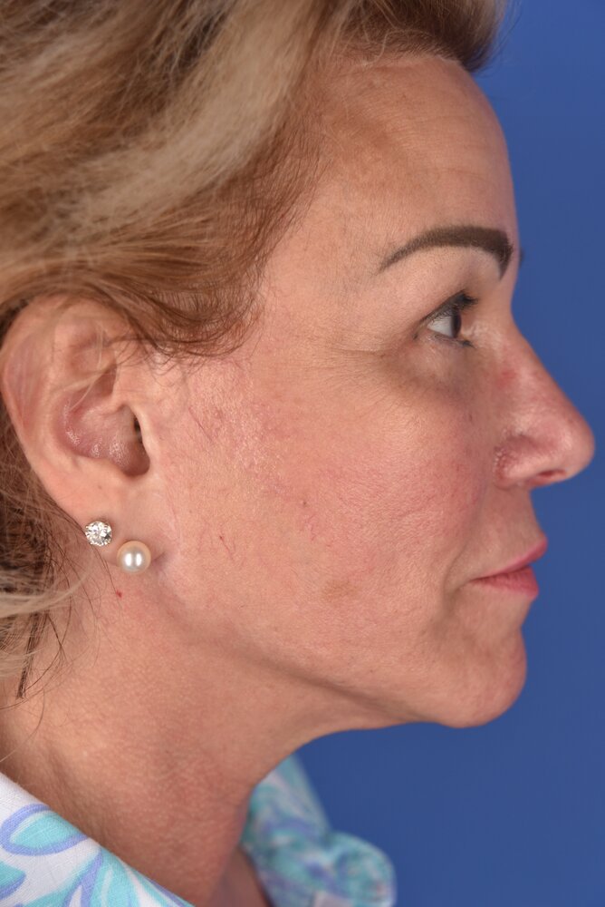 Rhinoplasty Before & After Image