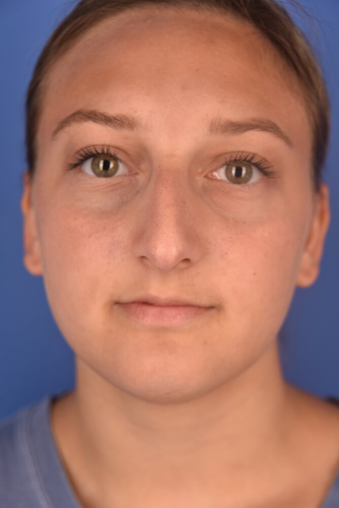 Rhinoplasty Before & After Image
