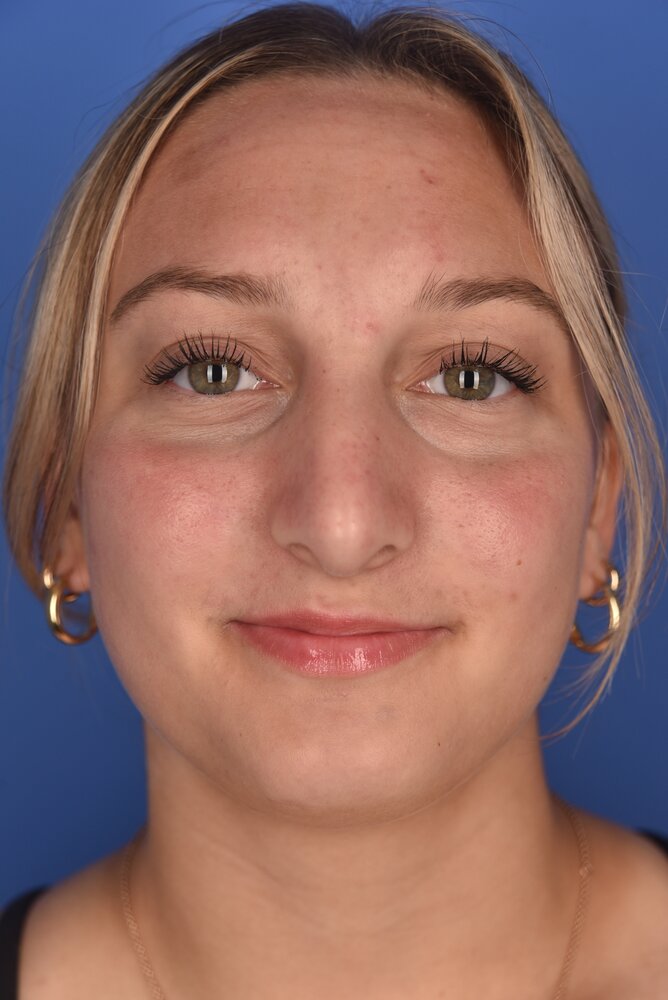 Rhinoplasty Before & After Image