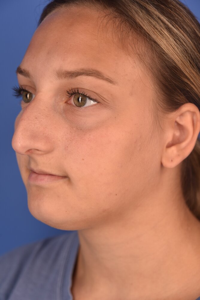Rhinoplasty Before & After Image
