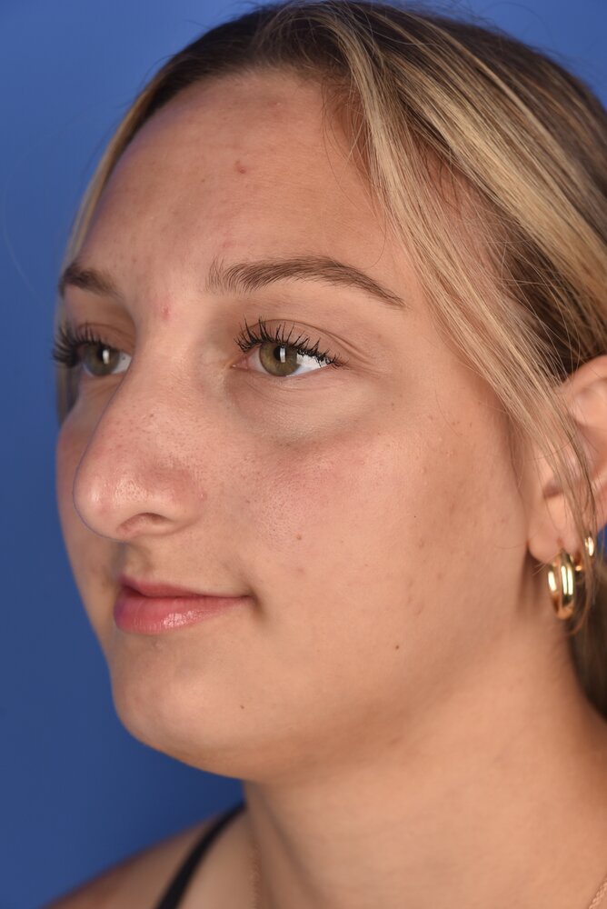 Rhinoplasty Before & After Image