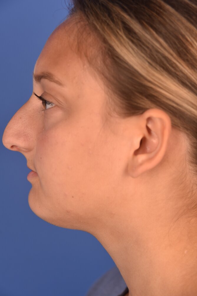 Rhinoplasty Before & After Image
