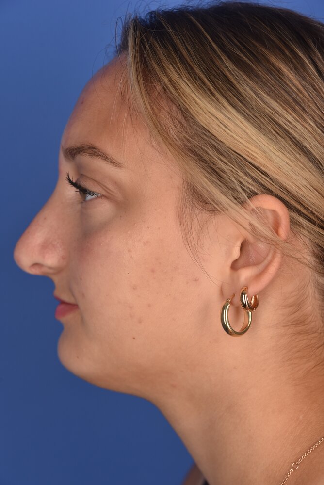 Rhinoplasty Before & After Image