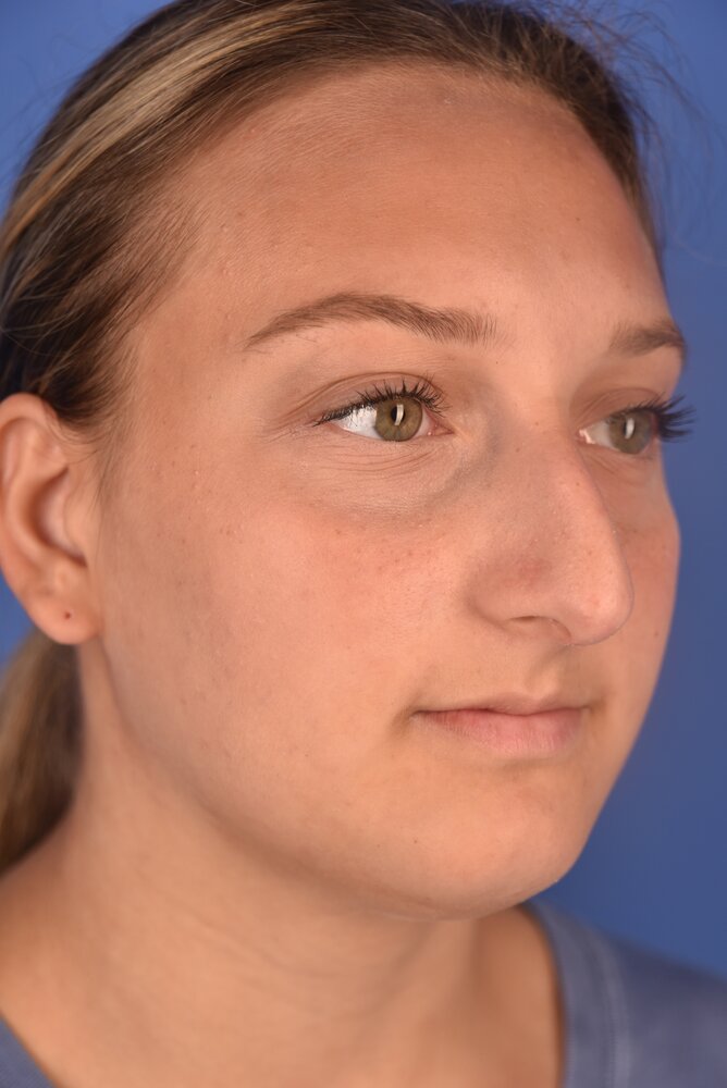 Rhinoplasty Before & After Image