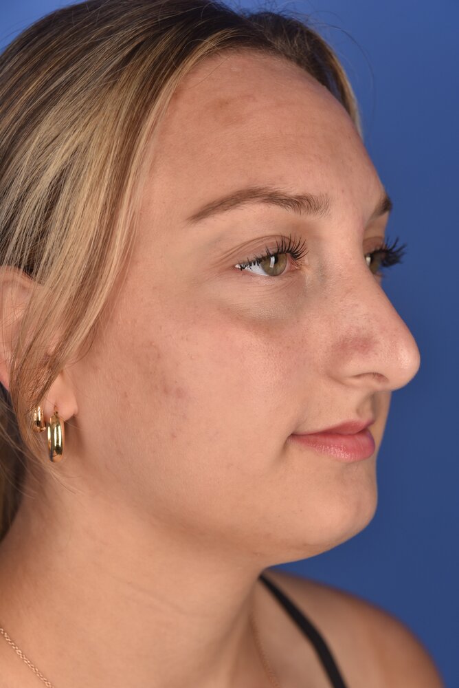 Rhinoplasty Before & After Image