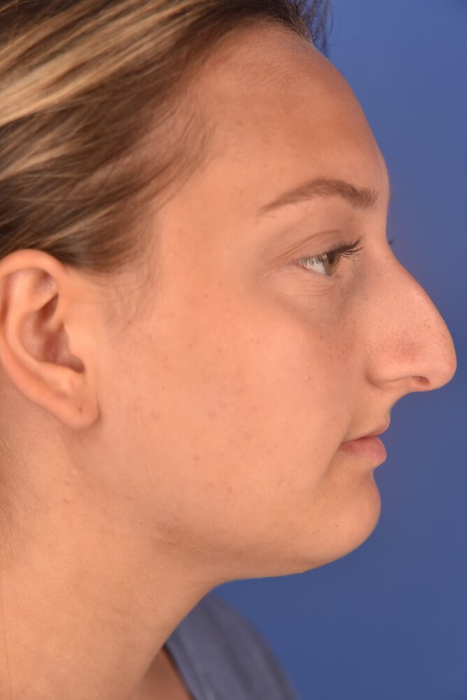 Rhinoplasty Before & After Image