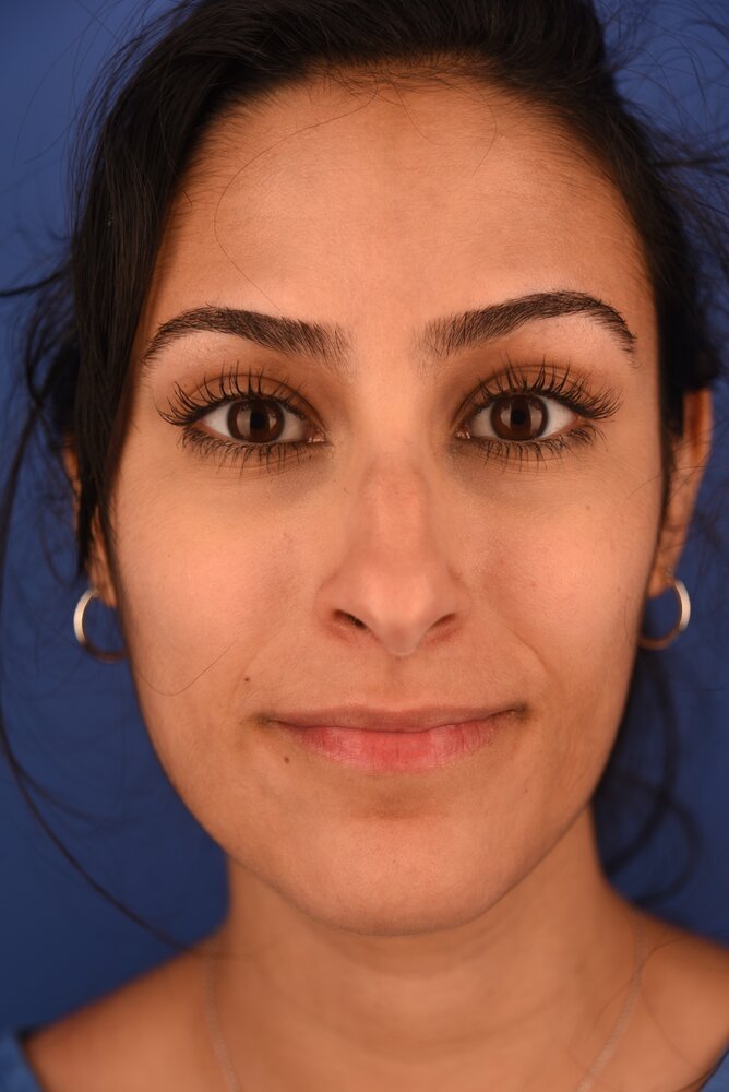Rhinoplasty Before & After Image