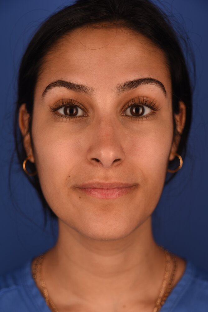 Rhinoplasty Before & After Image