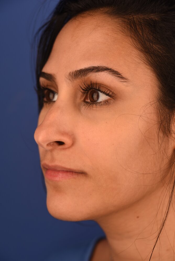 Rhinoplasty Before & After Image