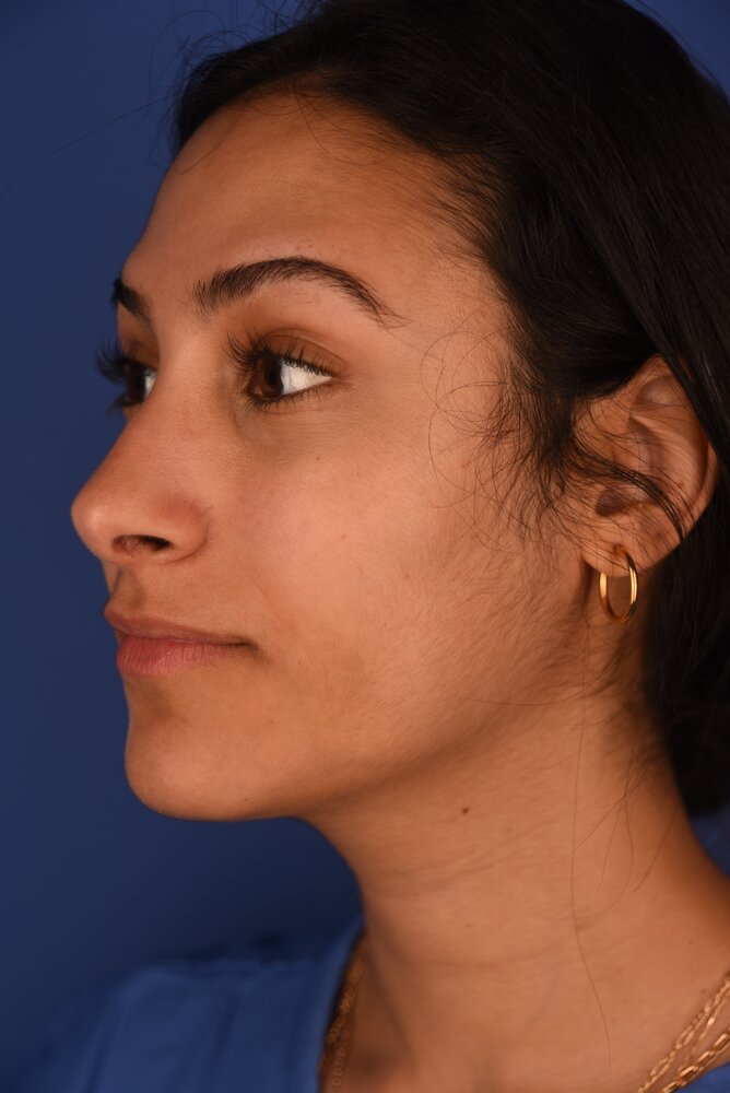 Rhinoplasty Before & After Image