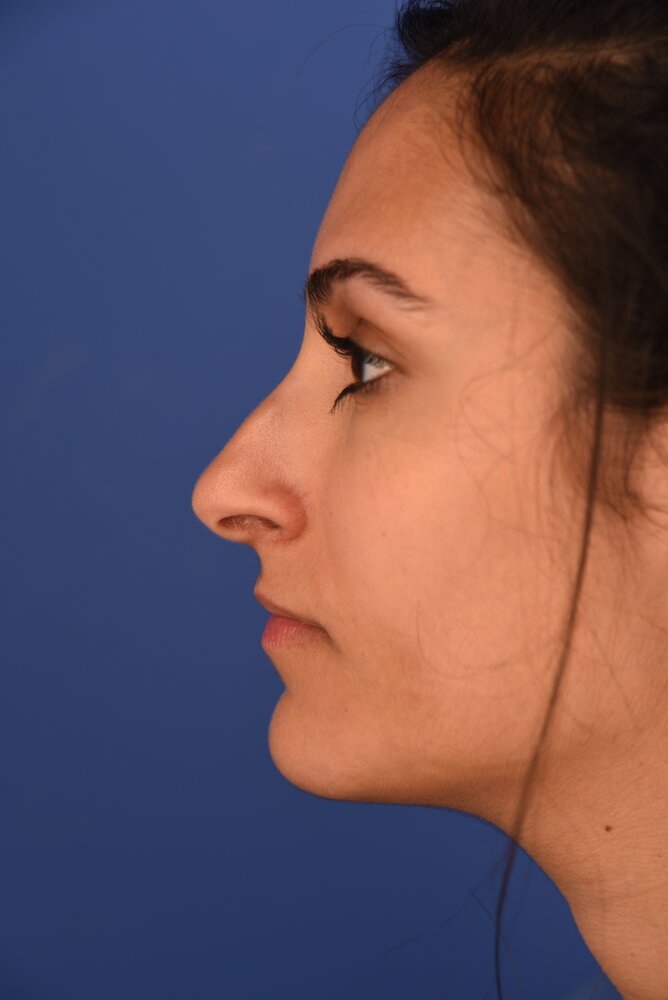 Rhinoplasty Before & After Image