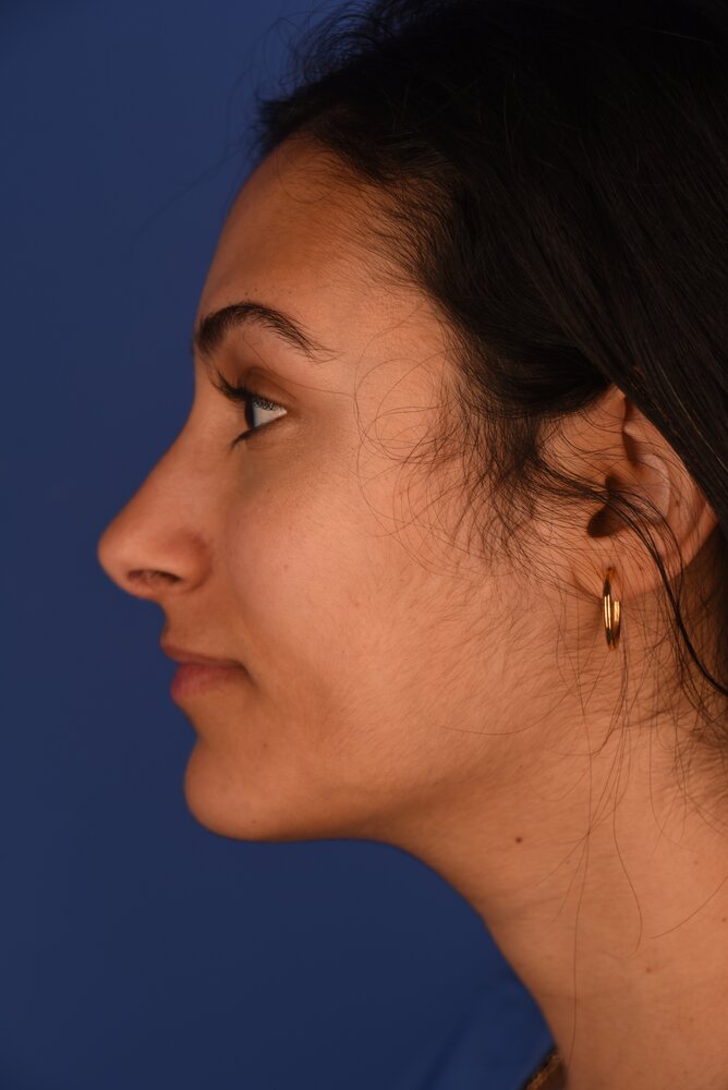 Rhinoplasty Before & After Image