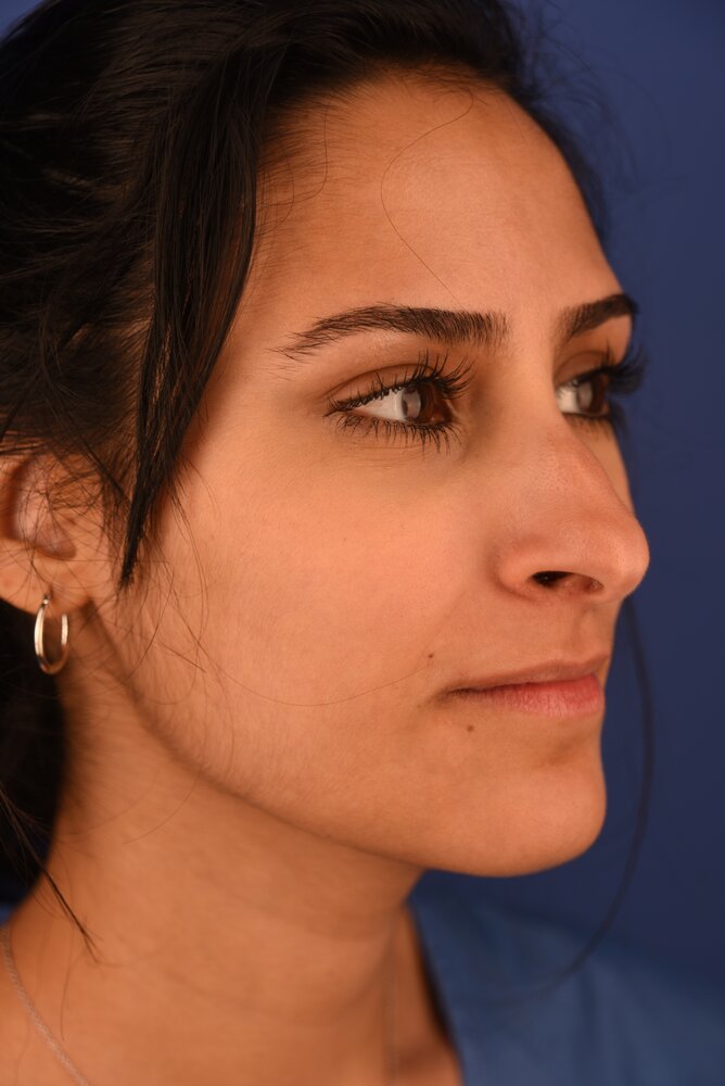 Rhinoplasty Before & After Image