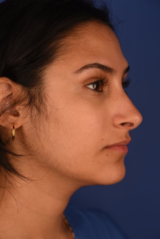 Rhinoplasty Before & After Image