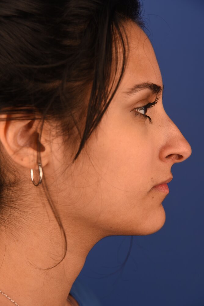 Rhinoplasty Before & After Image