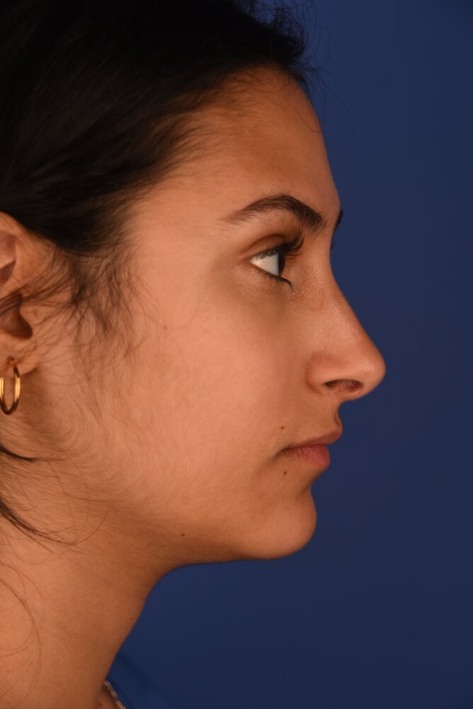 Rhinoplasty Before & After Image
