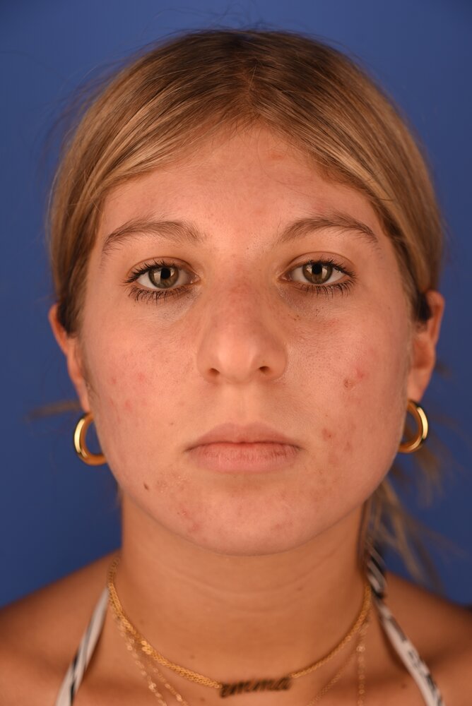 Rhinoplasty Before & After Image