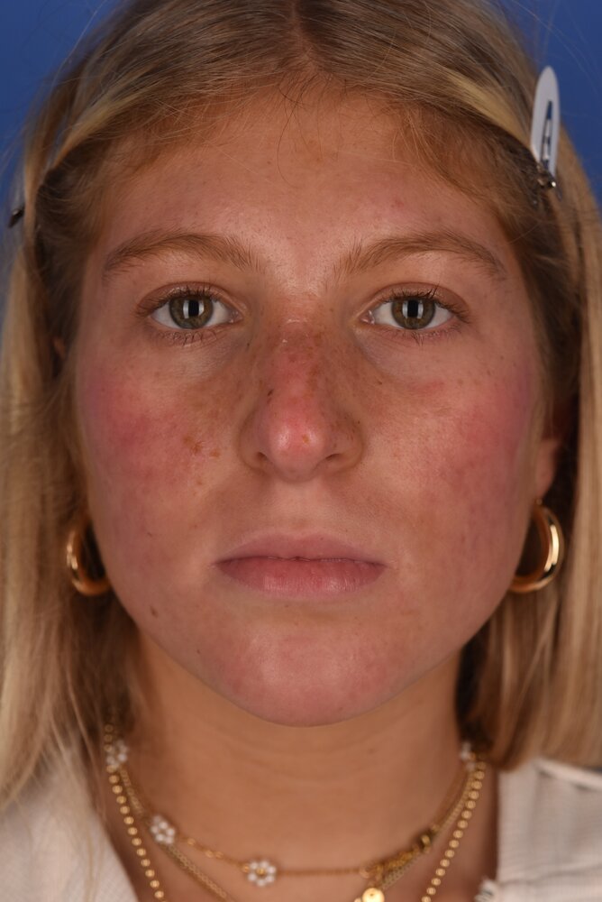 Rhinoplasty Before & After Image