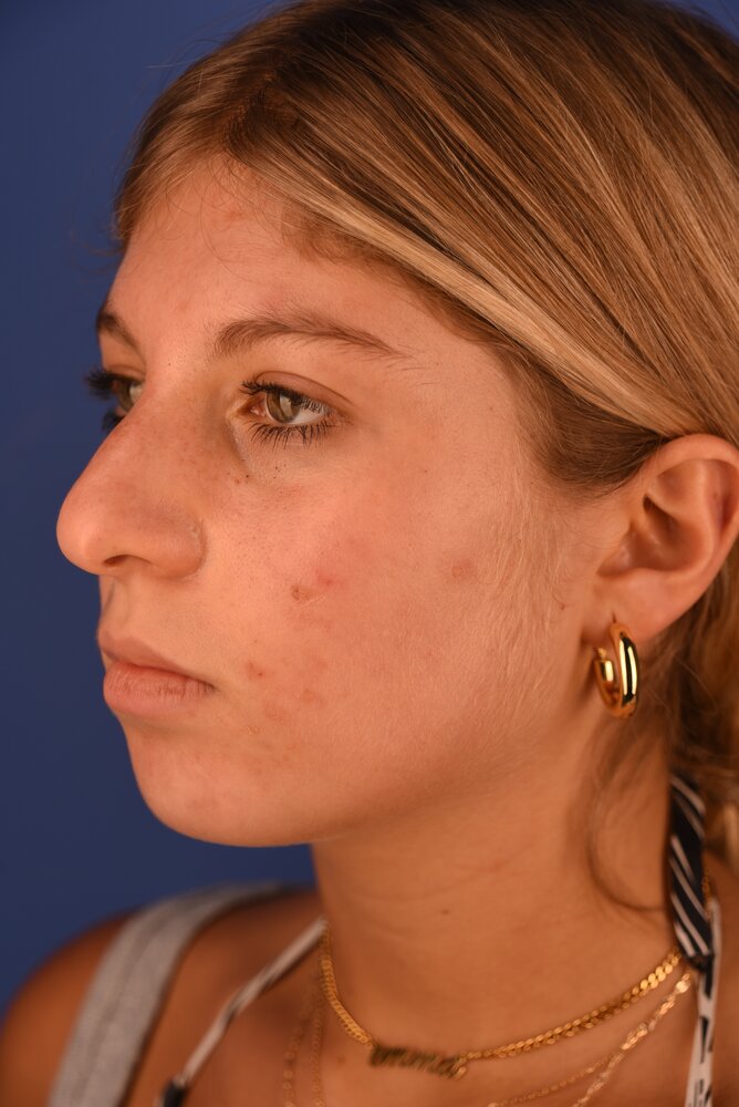 Rhinoplasty Before & After Image
