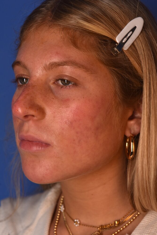 Rhinoplasty Before & After Image