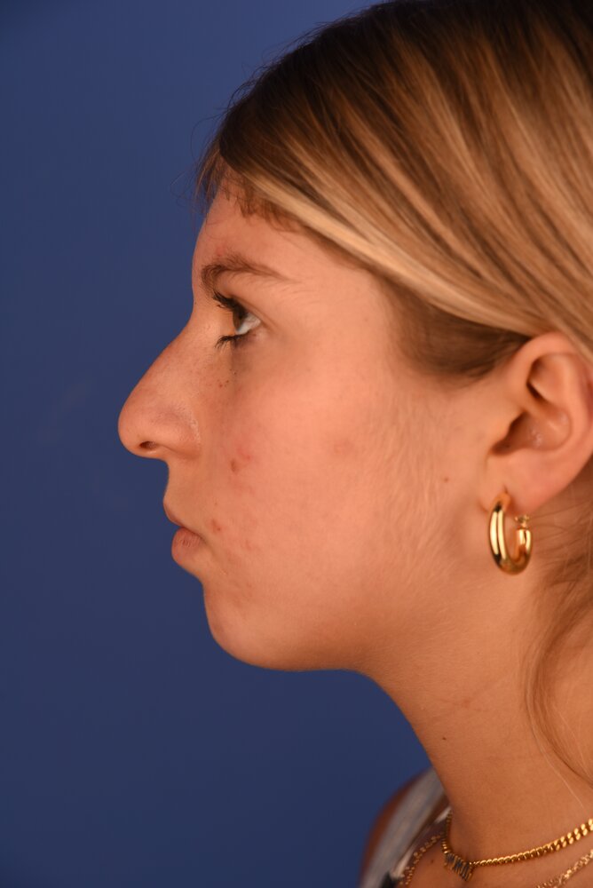 Rhinoplasty Before & After Image