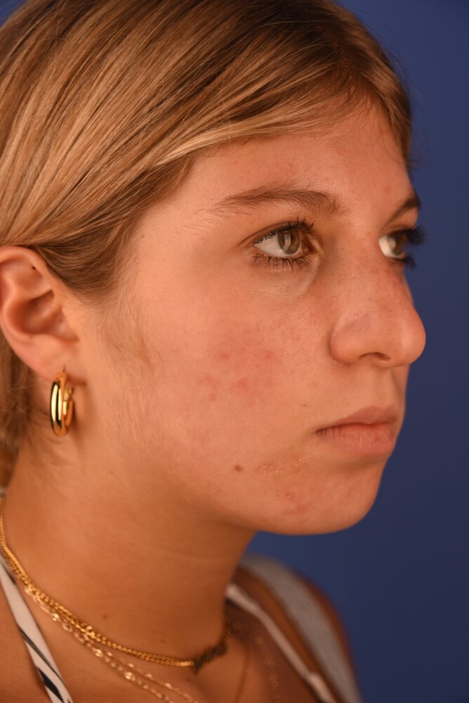 Rhinoplasty Before & After Image