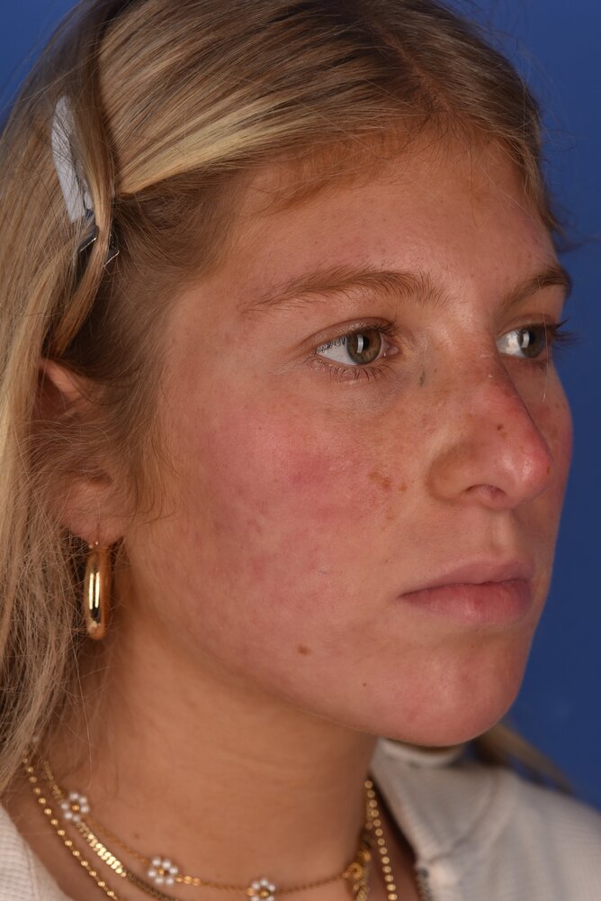 Rhinoplasty Before & After Image