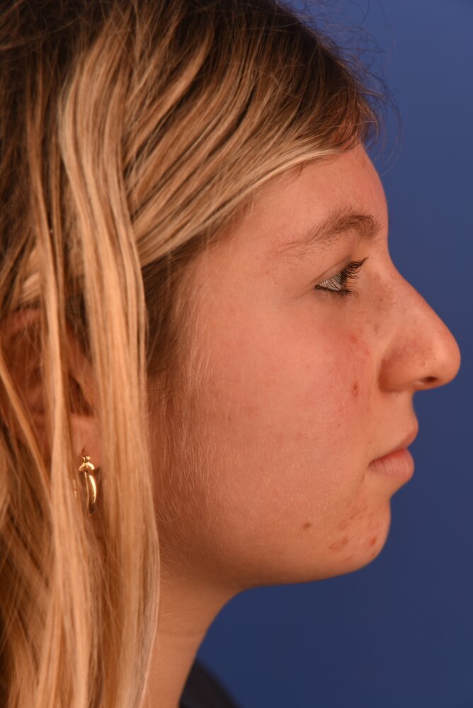 Rhinoplasty Before & After Image