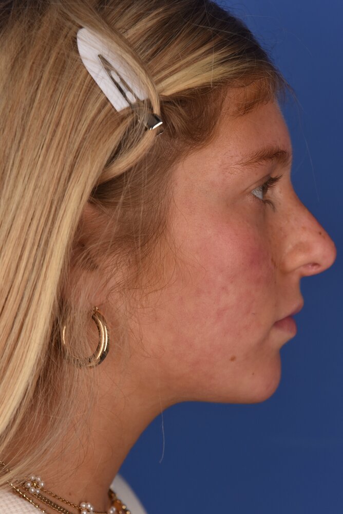 Rhinoplasty Before & After Image