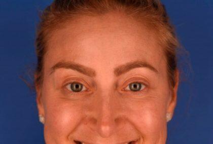 Botox Before & After Image