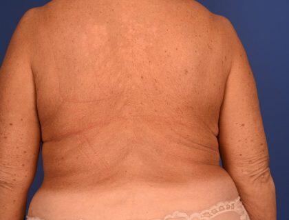 CoolSculpting Before & After Image