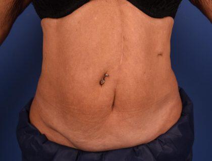 CoolSculpting Before & After Image