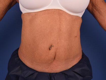 CoolSculpting Before & After Image