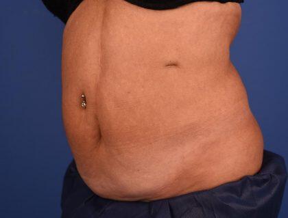 CoolSculpting Before & After Image