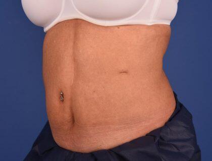 CoolSculpting Before & After Image