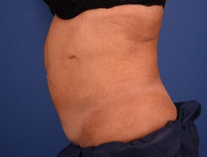 CoolSculpting Before & After Image