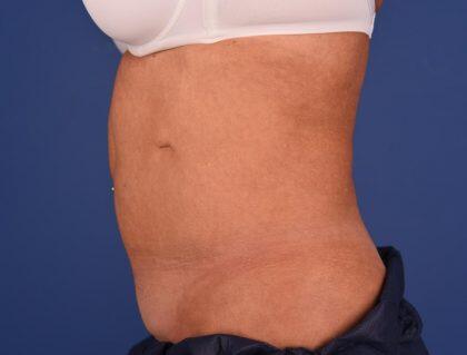 CoolSculpting Before & After Image