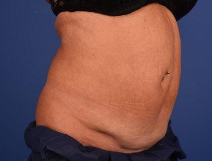 CoolSculpting Before & After Image