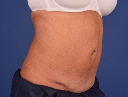 CoolSculpting Before & After Image