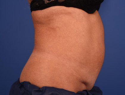 CoolSculpting Before & After Image