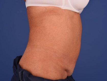 CoolSculpting Before & After Image