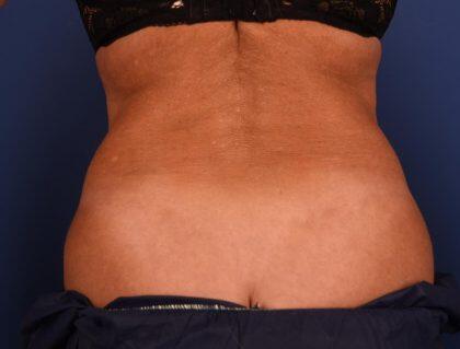 CoolSculpting Before & After Image