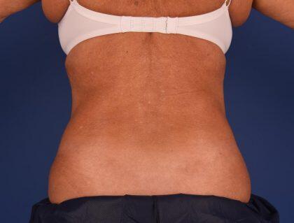 CoolSculpting Before & After Image